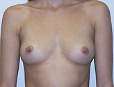 Patient # 59825 Before Photo # 1